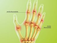 homeopatia para artrite
